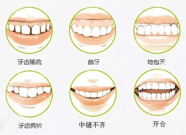 为何戴牙套会形成牙套脸？牙齿矫正冷知识分享！