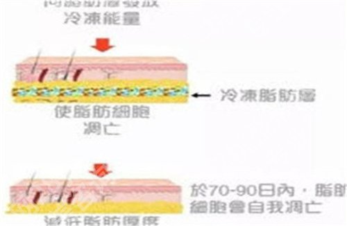 任学会吸脂修复价格，吸脂修复案例恢复步骤