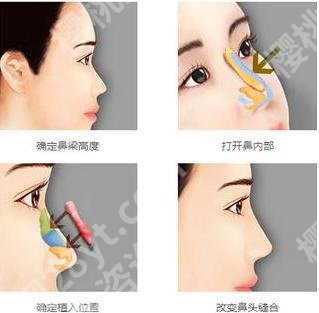 王志坚医生鼻子案例:假体隆鼻术后3个月反馈！附手术价格