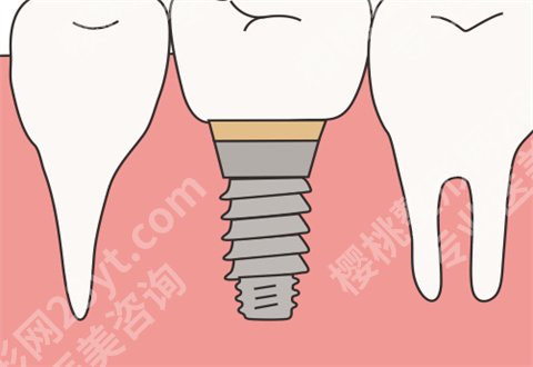 北京中诺口腔医院医生介绍，附种植牙案例反馈详情