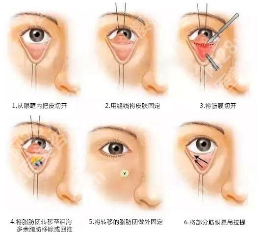 九院周显玉医生做眼袋怎么样？上海眼周抗衰专家实力测评！