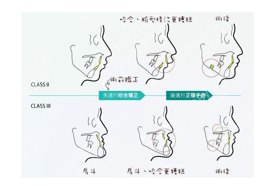 上海正颌医生高伟怎么样？个人简介\出诊医院\正颌案例