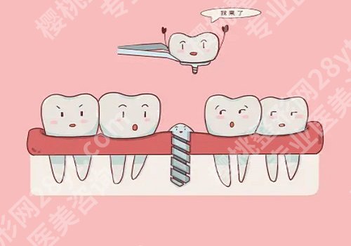 南京种植牙案例，牙齿真正得到了修复！