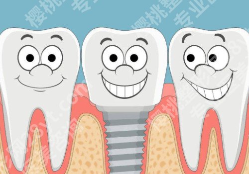无锡种植牙案例，手术过程相关情况分享！