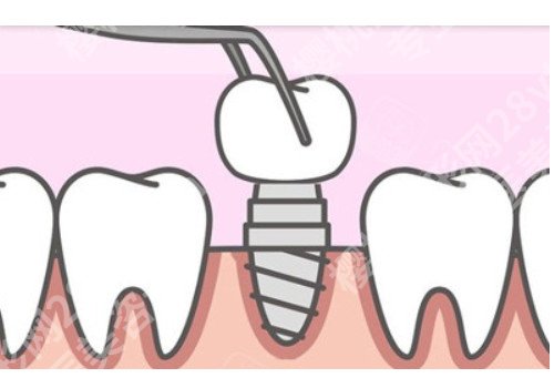 种植牙齿什么品牌比较好？手术基本知识科普！来了解下吧！