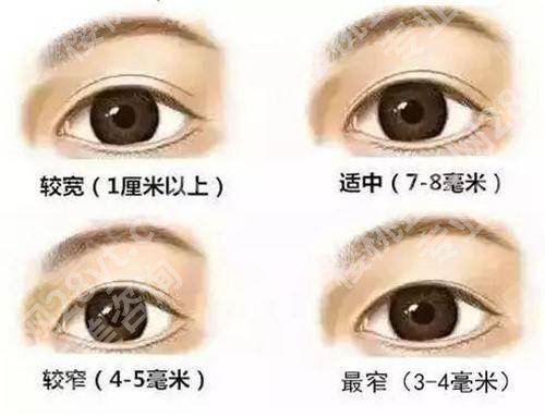 上海金蓉医生修复双眼皮怎么样？多少钱？专家实力还不错、价格4千元到5千元起！