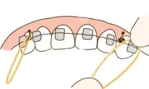 番禺中心医院牙科电话多少？口碑医生及牙齿矫正案例