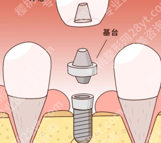 绍兴人民医院种牙怎么样？2024牙齿整形费用表曝光|附带案例