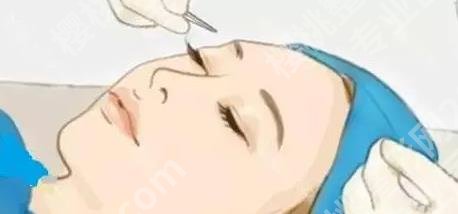 北京协和医院双眼皮案例曝光！眼部整形手术全过程记录！