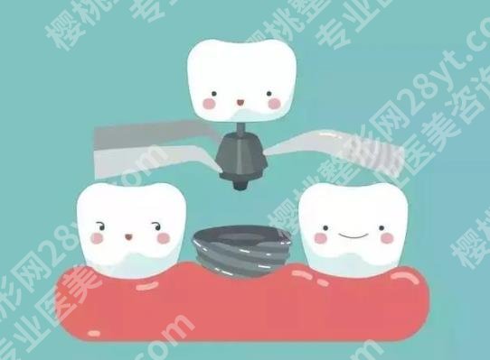 上海六院种牙预约多久？曹春花、朱红等医生技术不俗！牙齿案例