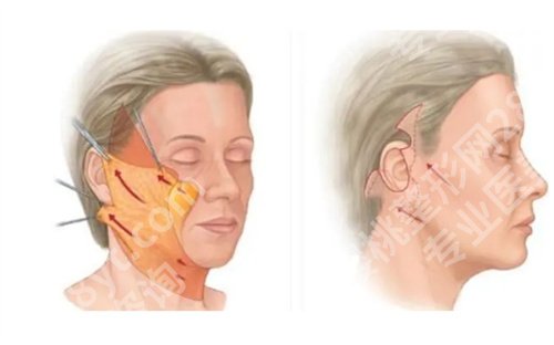 北京杨大平的面部提升切口位置在哪？医生技术点评来了，看细节