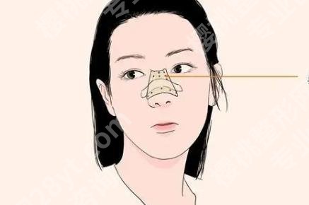 九院李青峰鼻子案例图曝光|手术前后小贴士分享！参考