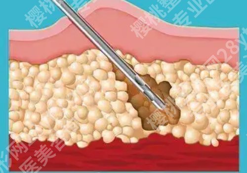 北京雅靓吸脂多少钱？内附医院、医生信息！