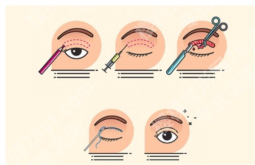 裴柄万做双眼皮价格是多少？看医生口碑如何，看细节