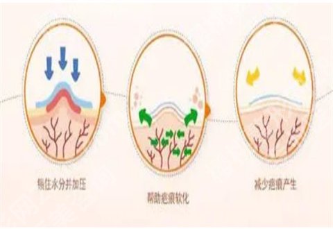 宋红霞治疗疤痕好吗？案例带你看术前术后详情