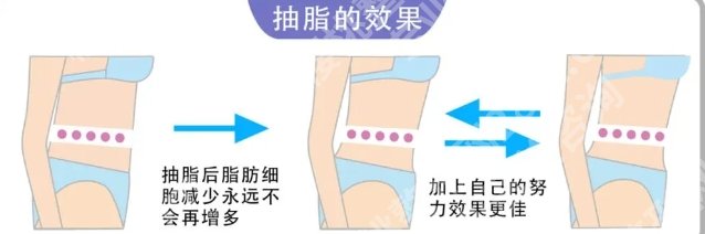 新桥医院整形科吸脂多少钱？院内哪位医生的技术比较好？真实口碑分享