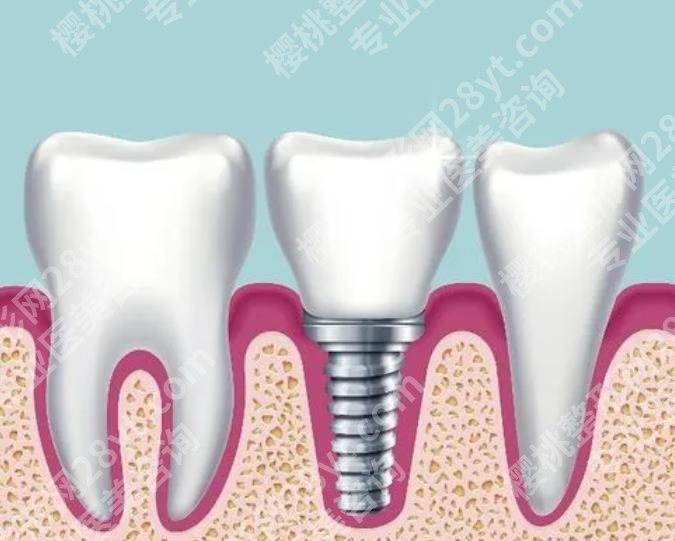 北大口腔医院牙齿种植价格多少？做牙齿种植前后注意事项分享！