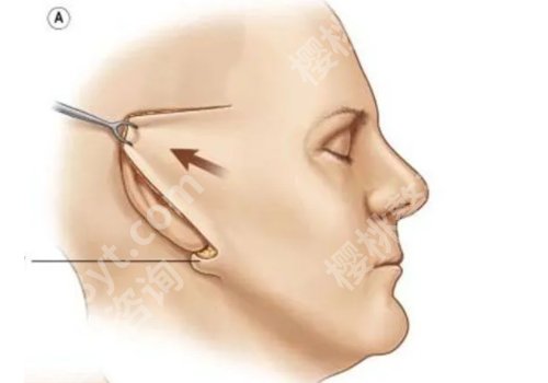 侯典举拉皮手术怎么样？医生技术测评及案例分享