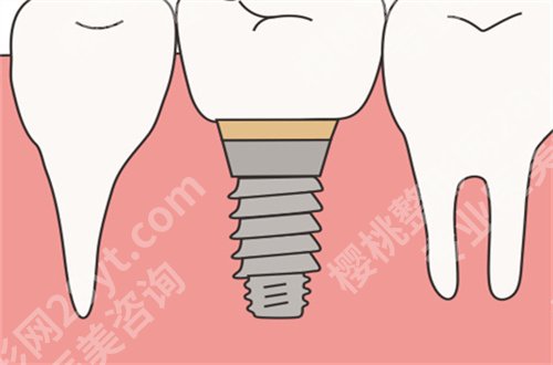 北京中诺口腔医院种植牙怎么样？好评不断，简介告知