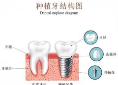 北京赛德阳光口腔种植牙价格？价格明细表，人气医生介绍