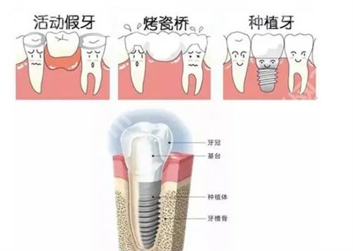 北京劲松口腔医院种植牙齿怎么样？主打项目收费明细