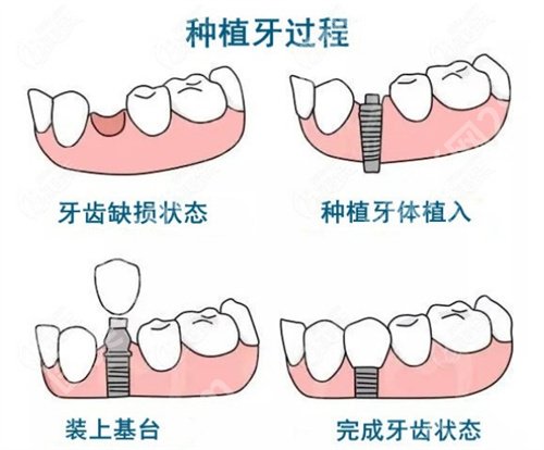 北京劲松口腔医院种植牙齿怎么样？主打项目收费明细