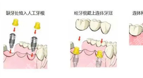 北京大学口腔医院第五门诊部种牙多少钱？医院实力曝光了