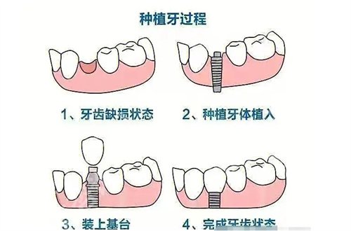 北京大学口腔医院种植科专家有谁？附价格明细+点评