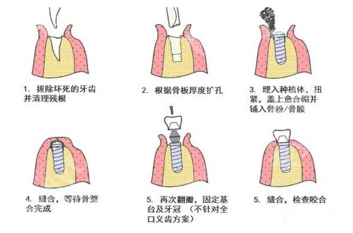 北京瑞泰口腔医院种植牙价格怎么样？附价格表详情