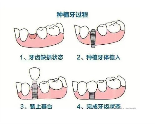 北京瑞城口腔医院种牙多少钱?看价格明细表来袭