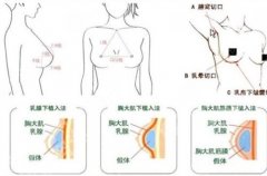 杭州抽脂隆胸手术的价格是多少？看详情介绍来袭