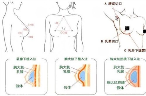 杭州抽脂隆胸手术的价格是多少？看详情介绍来袭