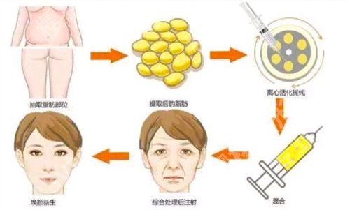 杭州郭同荣脂肪填充怎么样？坐诊医院、真实案例反馈来袭