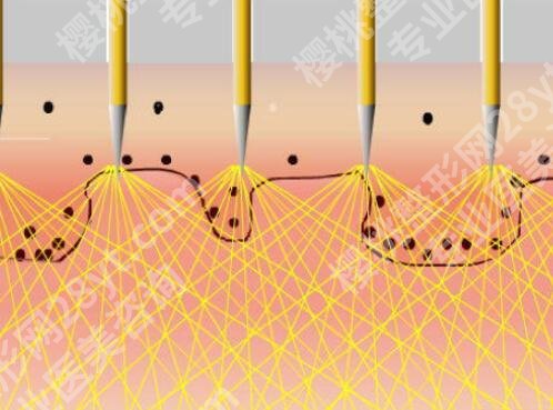 广州fotona4d pro正品认证机构如何？项目收费-注意事项在线了解