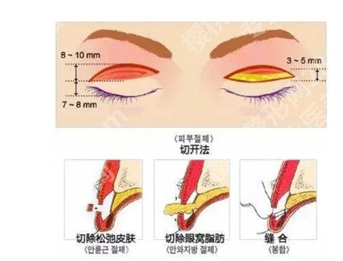 上海艺星整形医院做双眼皮怎么样啊？真实案例反馈来袭