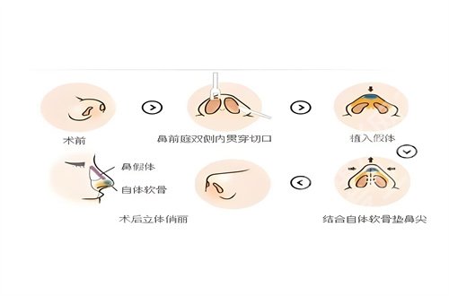 上海韩春民整形外科双眼皮怎么样？详细简介+真人案例解说