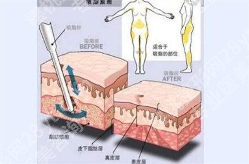 北京润美玉之光吸脂瘦腿价格贵呀！明星项目展开介绍