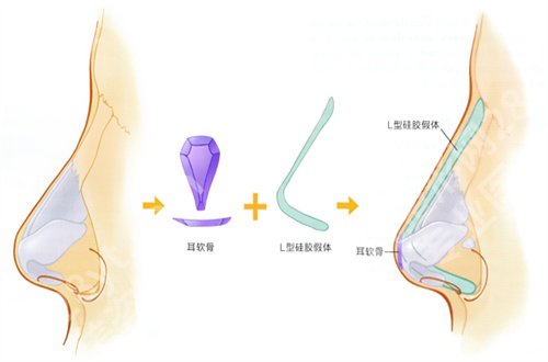 北京沃尔做鼻子技术怎么样？阐述优势所在