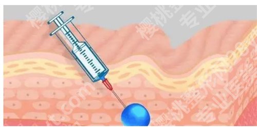 北京华韩医疗美容打玻尿酸怎么样？亮点公布了，附案例