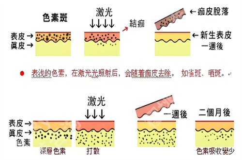 上海俏佳人点痣价格怎么样？收费明细已经公布了