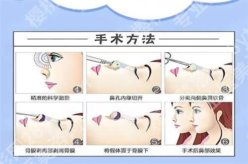 北京八大处假体隆胸价格表揭示，公布基本信息，附简介