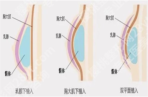 北京八大处假体隆胸价格表揭示，公布基本信息，附简介