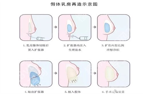 济南薛峰双眼皮案例公布，口碑点评揭示了，看细节