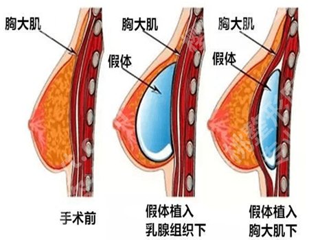 北京艺星假体隆胸怎么样？特色项目参考，真人案例品评