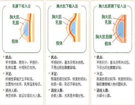 上海美联臣医疗美容医院丰胸价格多少钱？隆胸价格8900元起，更新网友评价