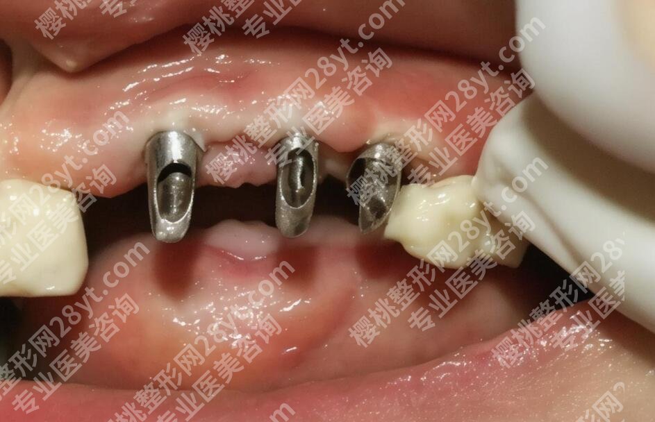 厦门思迈尔口腔怎么样？医院口碑评价|种牙案例展示！