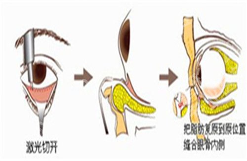 杭州第二人民医院祛眼袋多少钱？人气名单介绍