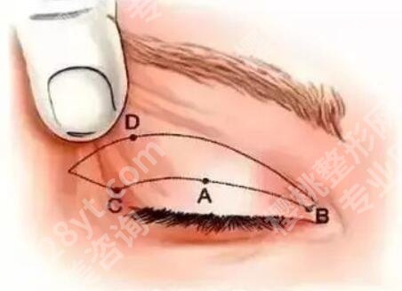 周珍艳双眼皮修复案例怎么样？盘点医生信息，含双眼皮修复案例过程