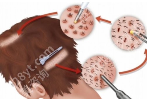 广州南方医院植发多少钱一个单位？医院实力曝光，一键查看