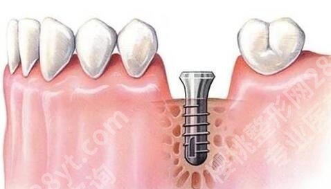 徐医附院牙齿种植怎么样？人气医院介绍和详细案例曝光
